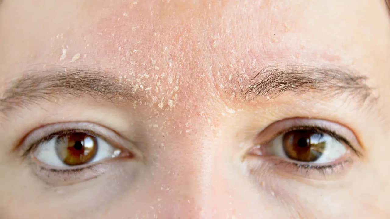 Gesichtshaut schuppt sich: Ursachen verstehen und effektiv behandeln