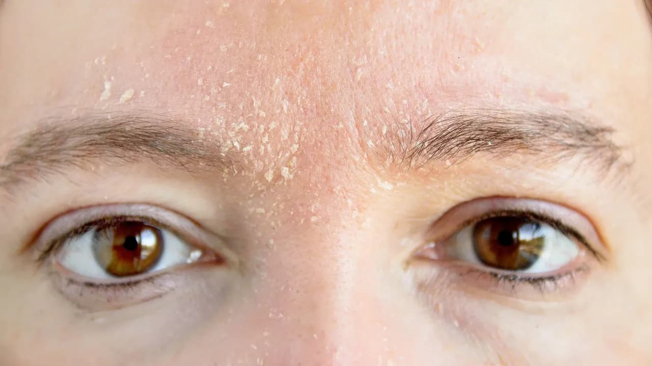 Gesichtshaut schuppt sich: Ursachen verstehen und effektiv behandeln