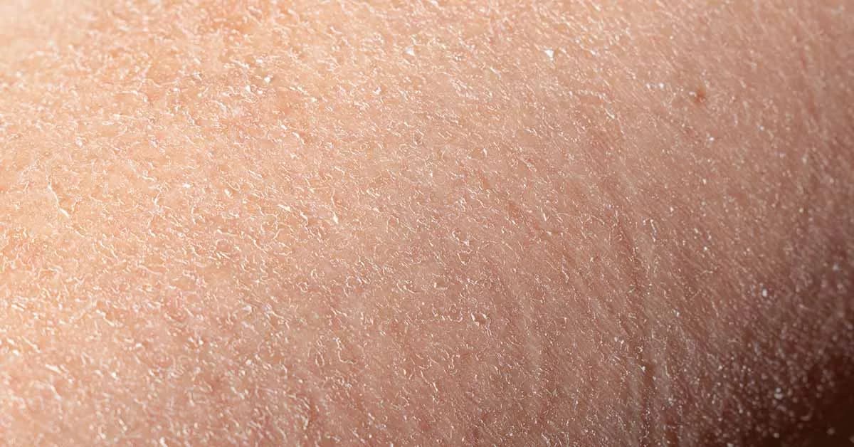 Ursachen und Lösungen für trockene schuppige Gesichtshaut verstehen