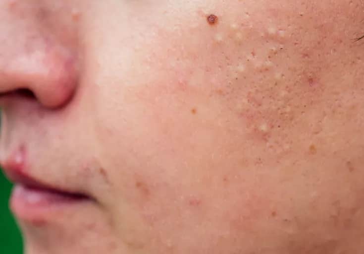 Trockene irritierte Gesichtshaut: Ursachen, Pflege und effektive Lösungen