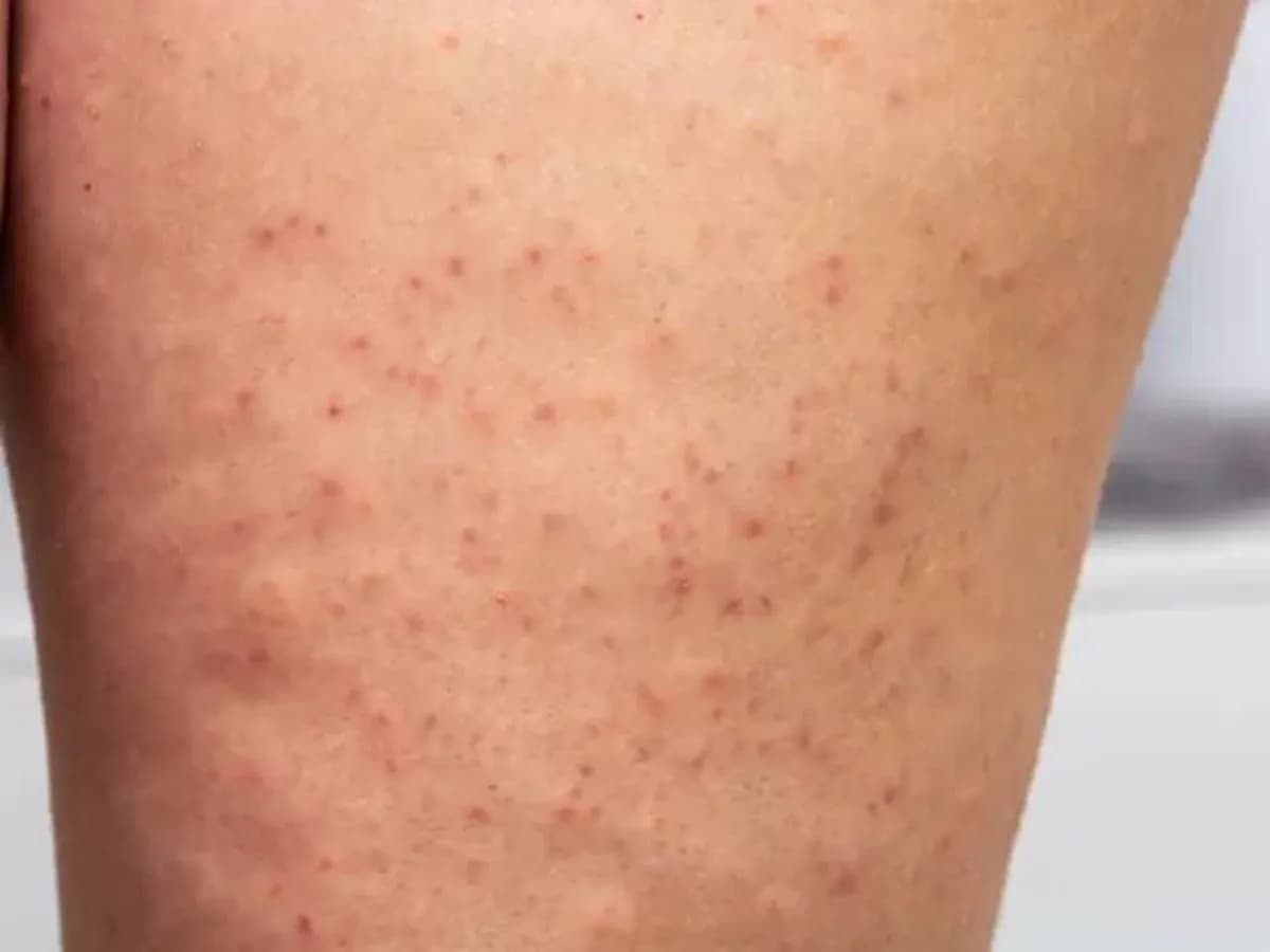 Eingewachsenes Haar am Bein: Ursachen, Behandlung und Vorbeugung