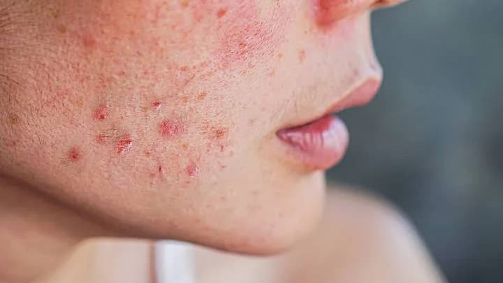 Ursachen für brennende Gesichtshaut: Symptome und wirksame Lösungen