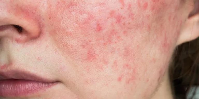 Gerötete Gesichtshaut: Ursachen, Symptome und effektive Behandlungsmöglichkeiten