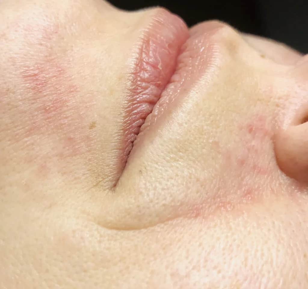 Raue Gesichtshaut: Ursachen und effektive Tipps zur Verbesserung