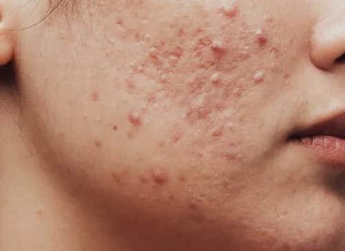 Unreine Gesichtshaut: Ursachen, Symptome und effektive Behandlungen