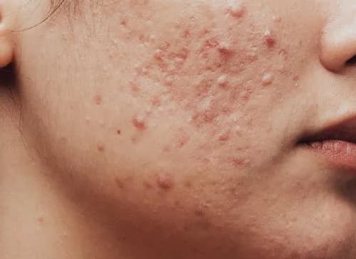 Unreine Gesichtshaut: Ursachen, Symptome und effektive Behandlungen